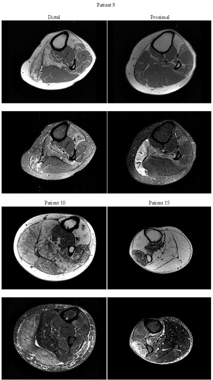 MRI of calf muscle