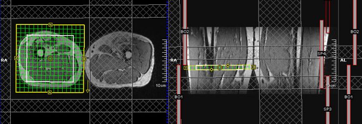 An MRI of the legs of a person with FSHD